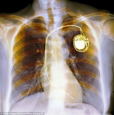 After almost 20 years of living with a pacemaker, Nina Adamowicz decided she no longer wanted the device that was keeping her alive